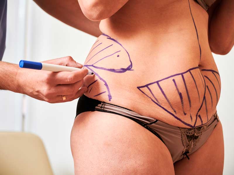 What Is the Difference Between Liposuction and Fat Transfer?