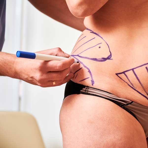 Liposuction vs Fat Transfer: What Is the Difference?